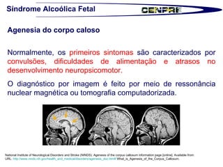 Síndrome Alcoólica Fetal Agenesia do corpo caloso Normalmente, os  primeiros sintomas  são caracterizados por  convulsões, dificuldades de alimentação e atrasos no desenvolvimento neuropsicomotor.  O diagnóstico por imagem é feito por meio de ressonância nuclear magnética ou tomografia computadorizada.  National Institute of Neurological Disorders and Stroke (NINDS). Agenesis of the corpus callosum information page [online]. Available from:  URL:  http://www.ninds.nih.gov/health_and_medical/disorders/agenesis_doc.htm#  What_is_Agenesis_of_the_Corpus_Callosum.  