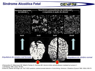 Síndrome Alcoólica Fetal 4.Ramanathan R, Wilkermeyer MF, Mittal B, Perides G, Charness ME. Alcohol inhibits cell-cell adhesion mediated by humans L1.  J Cell Biology 1996; 133(2): 381-90.  6.Sokol RJ, Martier SS & Ager JW. The T-ACE questions: pratical prenatal detection of risk-drinking. American J Obstetrics Gynecol 1989; 160(4): 863-70. Arquitetura do cérebro mal formado Arquitetura do cérebro normal 