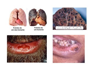 Lesões cancerosas da cavidade Bucal
 