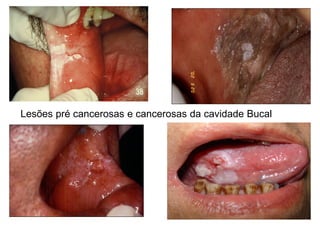 Cáncer de Labio
 