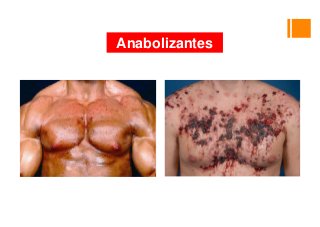 Anabolizantes
 