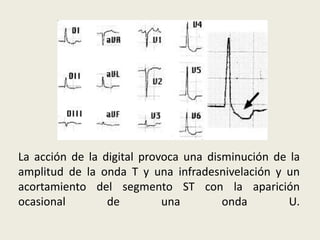 La acción de la digital provoca una disminución de la
amplitud de la onda T y una infradesnivelación y un
acortamiento del segmento ST con la aparición
ocasional
de
una
onda
U.

 