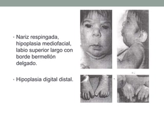 • Nariz respingada,
hipoplasia mediofacial,
labio superior largo con
borde bermellón
delgado.
• Hipoplasia digital distal.
 