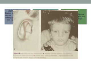 Micr
bilater
veces
con ag
del c
diacos
efectos
alida
otia o anotia, es
al (asimétrica), a Paladar hendido y
aparecen junto desarrollo anómalo de Problemas car
enesia o estenosis los huesos faciales y conotroncales o d
onducto auditivo cráneo en la vía de s
externo
¡Hidrocefalia: SNC! Timo: aplasia, hipoplasia
o posición anormal.
 