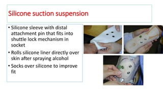 • Silicone sleeve with distal
attachment pin that fits into
shuttle lock mechanism in
socket
• Rolls silicone liner directly over
skin after spraying alcohol
• Socks over silicone to improve
fit
Silicone suction suspension
 