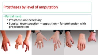 Prostheses by level of amputation
• Partial hand
• Prosthesis not necessary
• Surgical reconstruction – opposition – for prehension with
proprioception
 
