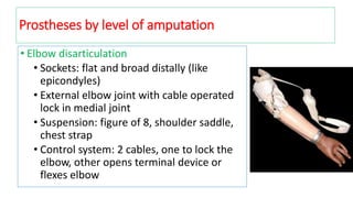 • Elbow disarticulation
• Sockets: flat and broad distally (like
epicondyles)
• External elbow joint with cable operated
lock in medial joint
• Suspension: figure of 8, shoulder saddle,
chest strap
• Control system: 2 cables, one to lock the
elbow, other opens terminal device or
flexes elbow
Prostheses by level of amputation
 