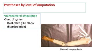 Above elbow prosthesis
Prostheses by level of amputation
•Transhumeral amputation
•Control system
Dual cable (like elbow
disarticulation)
 