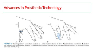 Advances in Prosthetic Technology
 
