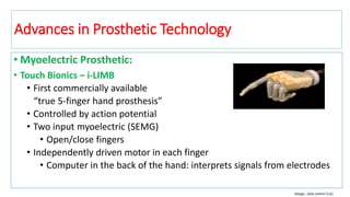 • Myoelectric Prosthetic:
• Touch Bionics – i-LIMB
• First commercially available
“true 5-finger hand prosthesis”
• Controlled by action potential
• Two input myoelectric (SEMG)
• Open/close fingers
• Independently driven motor in each finger
• Computer in the back of the hand: interprets signals from electrodes
Image , data source [12]
Advances in Prosthetic Technology
 