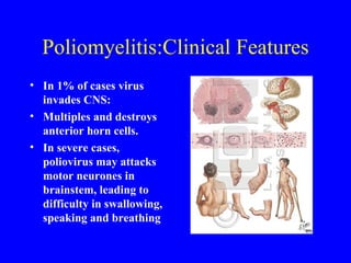Poliomyelitis:Clinical Features In 1% of cases virus invades CNS:  Multiples and destroys anterior horn cells. In severe cases, poliovirus may attacks motor neurones in brainstem, leading to difficulty in swallowing, speaking and breathing 