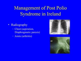 Management of Post Polio Syndrome in Ireland Radiography Chest (aspiration, Diaphragmatic paresis) Joints (arthritis) 