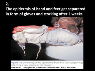 2-
The epidermis of hand and feet get separated
in form of gloves and stocking after 2 weeks
 