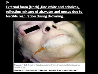 3-
External foam (froth) ,fine white and odorless,
reflecting mixture of air,water and mucus due to
forcible respiration during drowning.
 