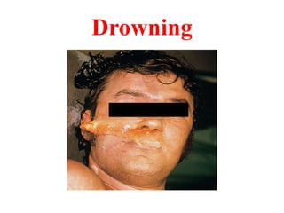 Drowning 