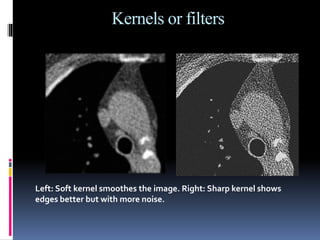 Sharp Kernel Ct Algorithm Basic Principles and Concepts of Computed Tomography (CT) | PPTX | 3-D ...