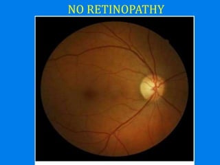 NO RETINOPATHY
 