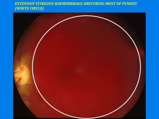 EXTENSIVE VITREOUS HAEMORRHAGE OBSCURING MOST OF FUNDUS
(WHITE CIRCLE)
 