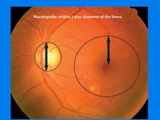 Maculopathy within 1 disc diameter of the fovea.
 