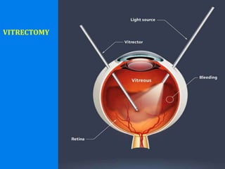 VITRECTOMY
 