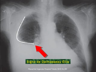 Signo de Daimasseau Ellis Manual de Urgencias Hospital Toledo 2010 3ra ED 