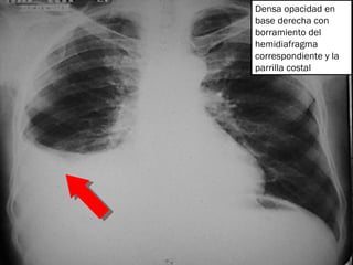 Densa opacidad en base derecha con borramiento del hemidiafragma correspondiente y la parrilla costal 