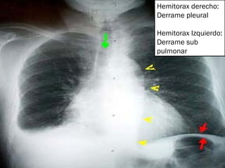 Hemitorax derecho: Derrame pleural Hemitorax Izquierdo: Derrame sub pulmonar 