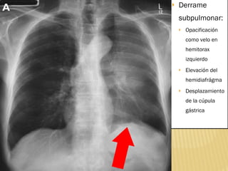 Derrame subpulmonar: Opacificación como velo en hemitorax izquierdo Elevación del hemidiafrágma Desplazamiento de la cúpula gástrica 