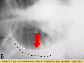 Donnely E. F.  MD. PhD. ;Medical Student’s Guide to Plain Chest Film 2006; 1ra ED ISBN 1-4116-9538-0  