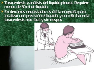 Toracentesis y análisis del líquido pleural. Requiere menos de 30 ml de líquido.  En derrames enquistados es útil la ecografía para localizar con precisión el líquido, y con ello hacer la toracentesis más fácil y sin riesgos  