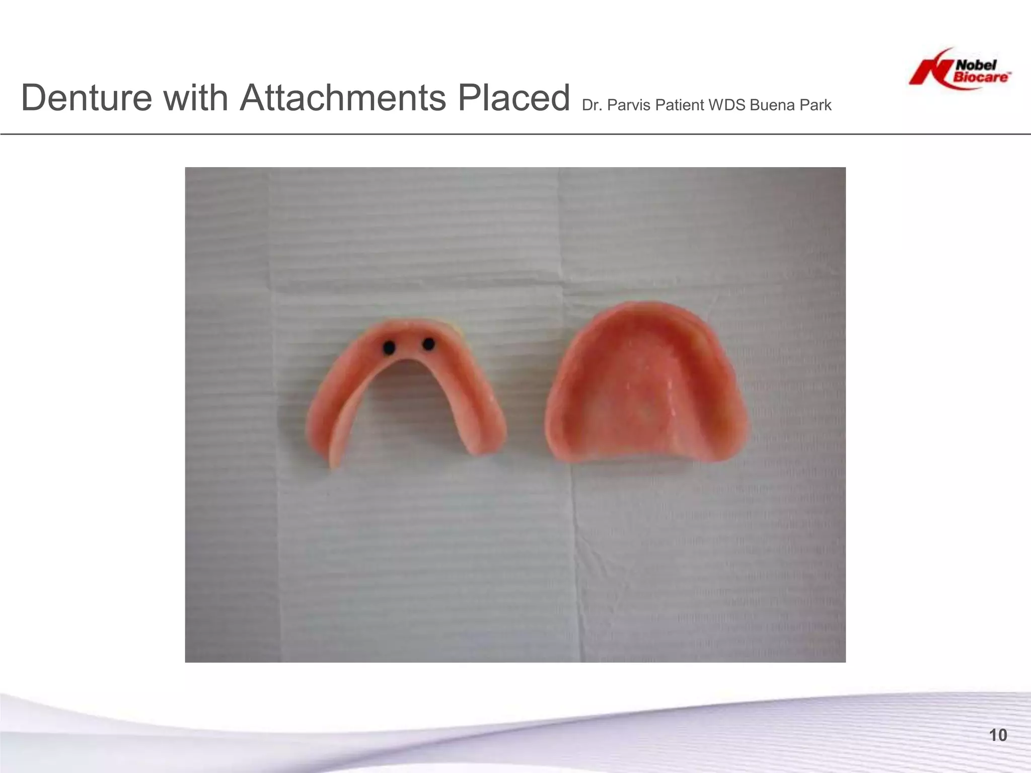 Denture with Attachments Placed Dr. Parvis Patient WDS Buena Park




                                                                    10
 