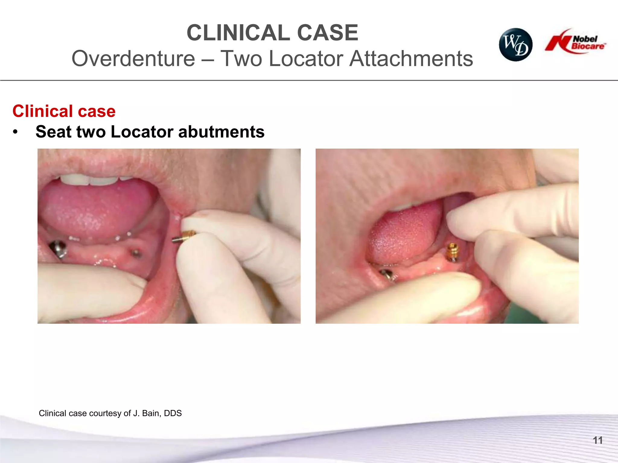 CLINICAL CASE
          Overdenture – Two Locator Attachments

Clinical case
• Seat two Locator abutments




  Clinical case courtesy of J. Bain, DDS


                                                  11
 