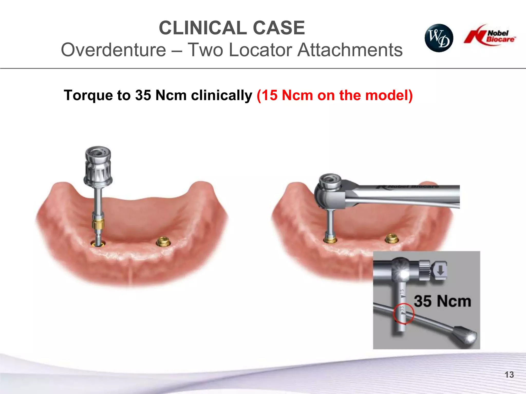 CLINICAL CASE
Overdenture – Two Locator Attachments

Torque to 35 Ncm clinically (15 Ncm on the model)




                                                    13
 