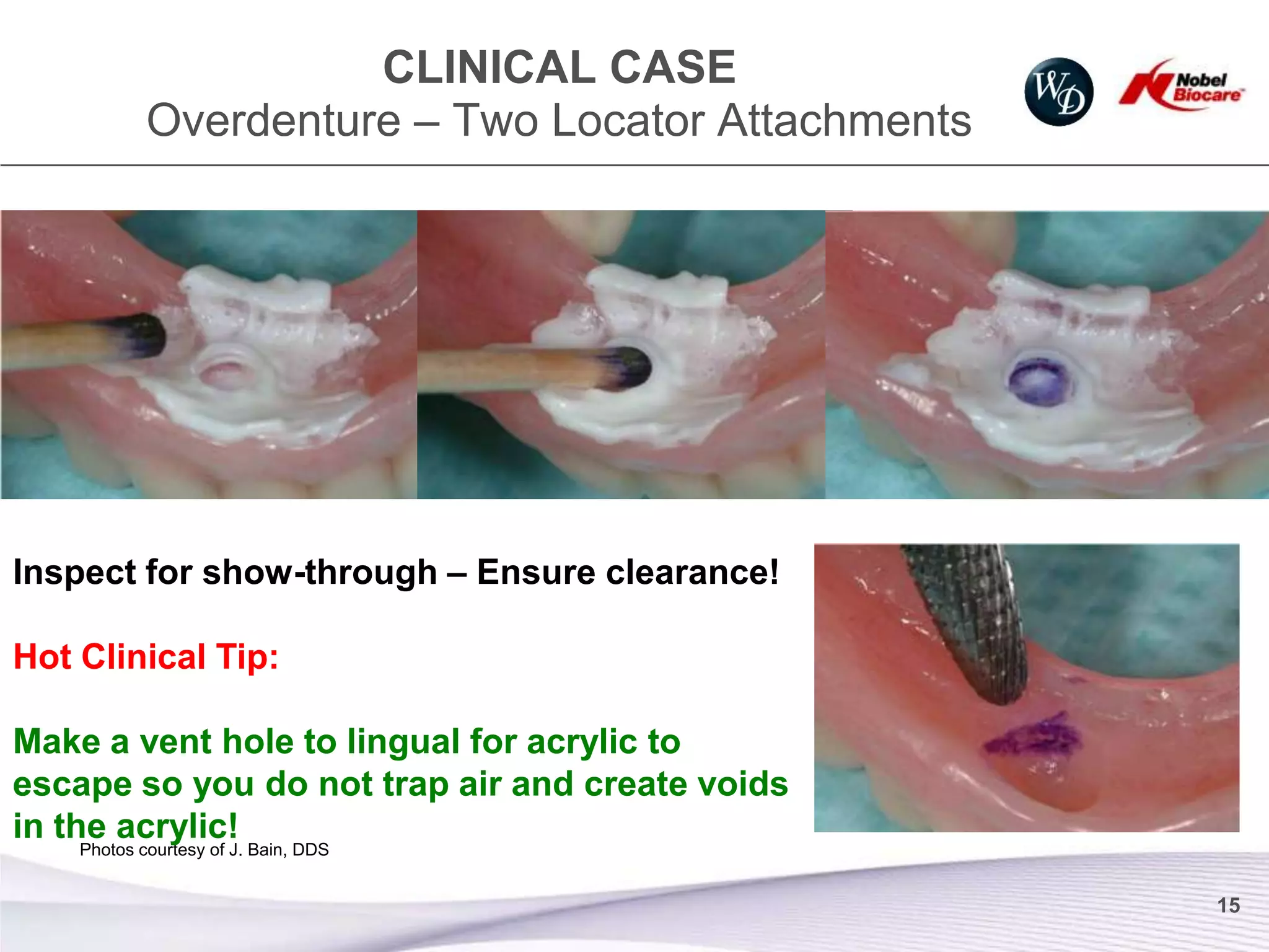 CLINICAL CASE
            Overdenture – Two Locator Attachments




Inspect for show-through – Ensure clearance!

Hot Clinical Tip:

Make a vent hole to lingual for acrylic to
escape so you do not trap air and create voids
in the acrylic!
    Photos courtesy of J. Bain, DDS


                                                    15
 
