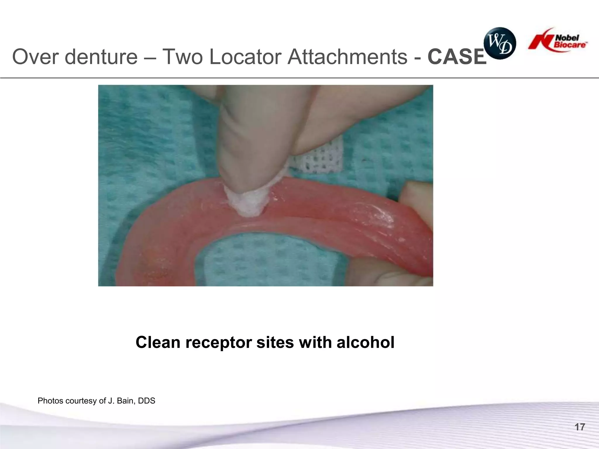Over denture – Two Locator Attachments - CASE




                           Clean receptor sites with alcohol


  Photos courtesy of J. Bain, DDS


                                                               17
 