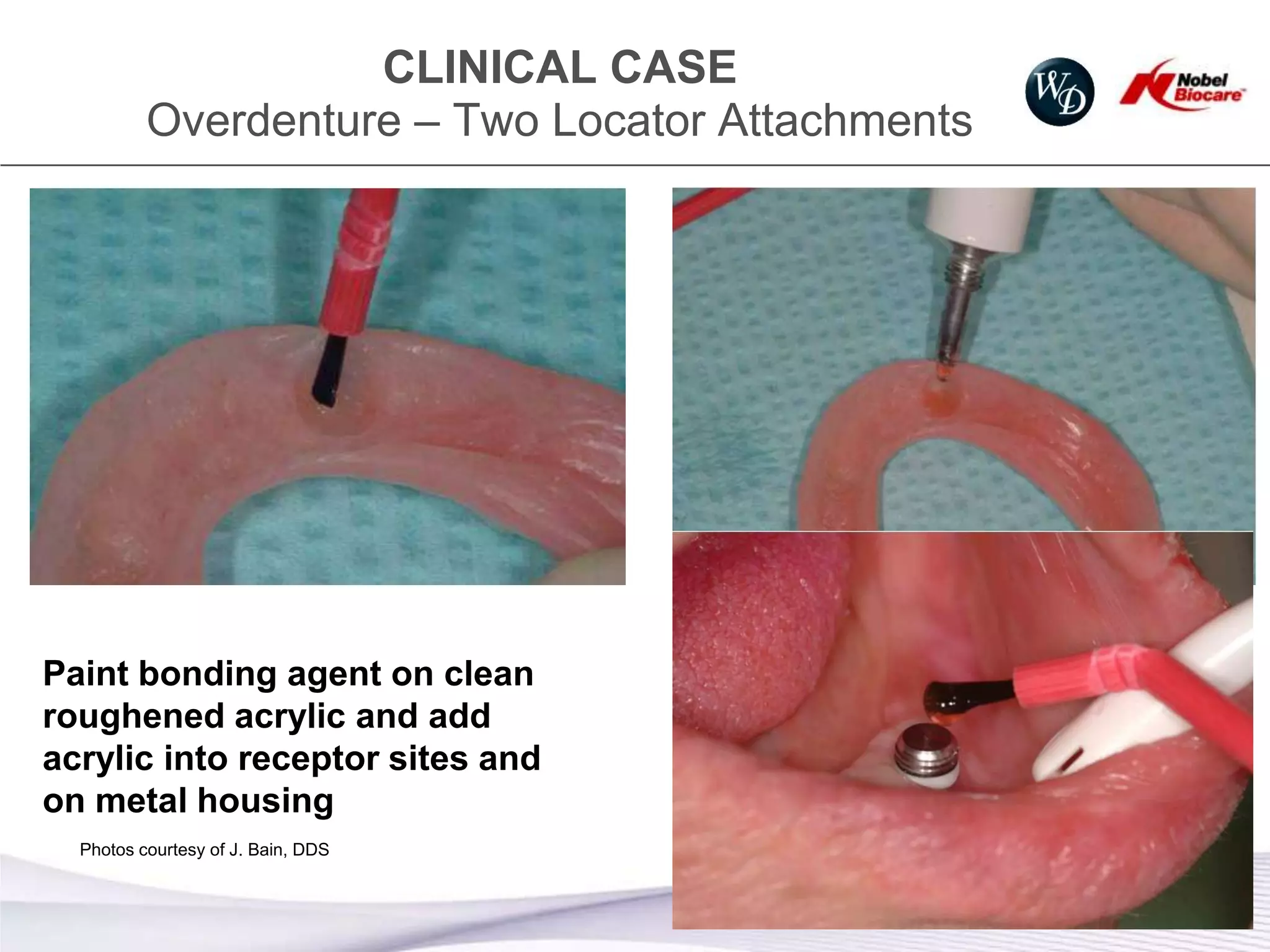 CLINICAL CASE
          Overdenture – Two Locator Attachments




Paint bonding agent on clean
roughened acrylic and add
acrylic into receptor sites and
on metal housing
  Photos courtesy of J. Bain, DDS


                                                  18
 