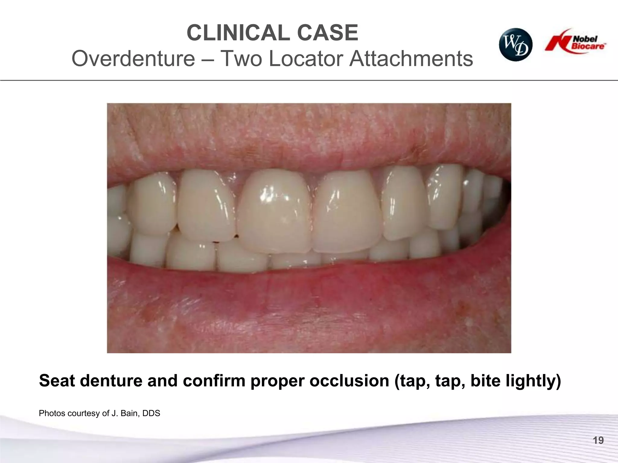 CLINICAL CASE
        Overdenture – Two Locator Attachments




Seat denture and confirm proper occlusion (tap, tap, bite lightly)
Photos courtesy of J. Bain, DDS


                                                                     19
 