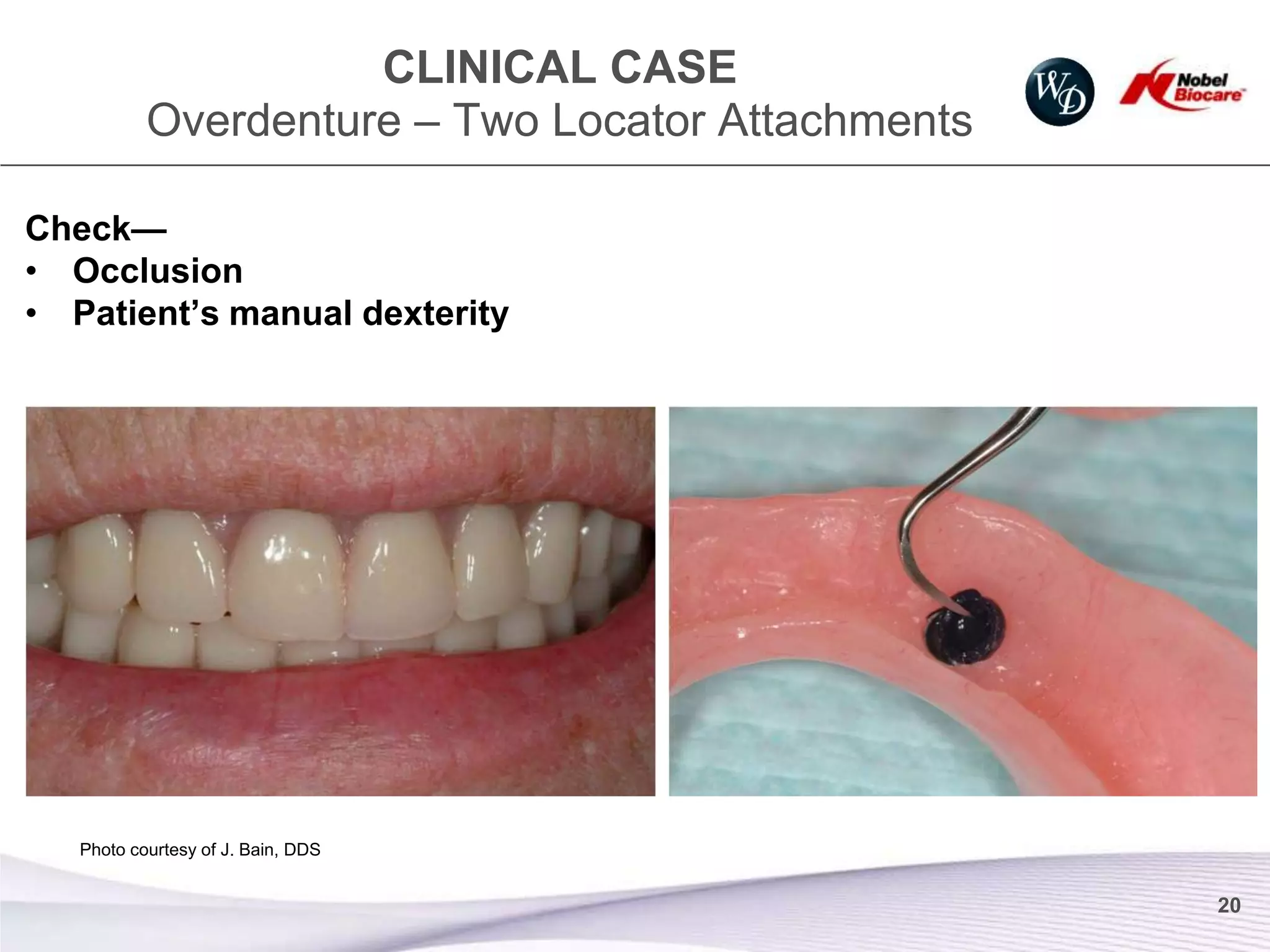 CLINICAL CASE
           Overdenture – Two Locator Attachments

Check—
• Occlusion
• Patient’s manual dexterity




   Photo courtesy of J. Bain, DDS


                                                   20
 