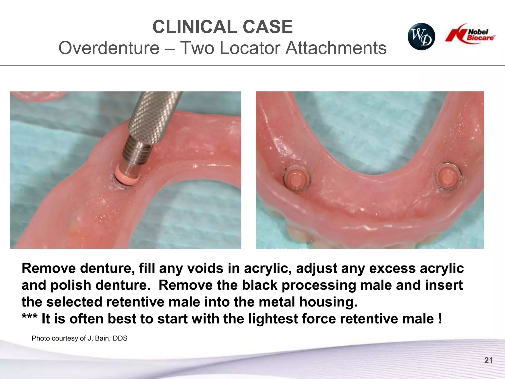 CLINICAL CASE
         Overdenture – Two Locator Attachments




Remove denture, fill any voids in acrylic, adjust any excess acrylic
and polish denture. Remove the black processing male and insert
the selected retentive male into the metal housing.
*** It is often best to start with the lightest force retentive male !
 Photo courtesy of J. Bain, DDS


                                                                         21
 