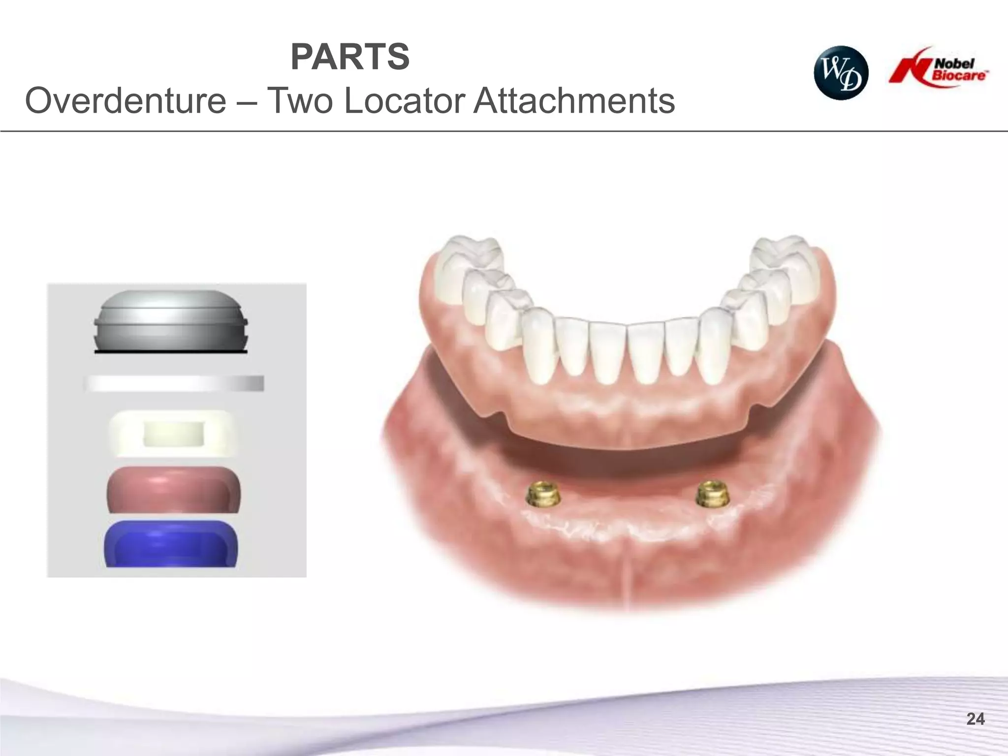 PARTS
Overdenture – Two Locator Attachments




                                        24
 