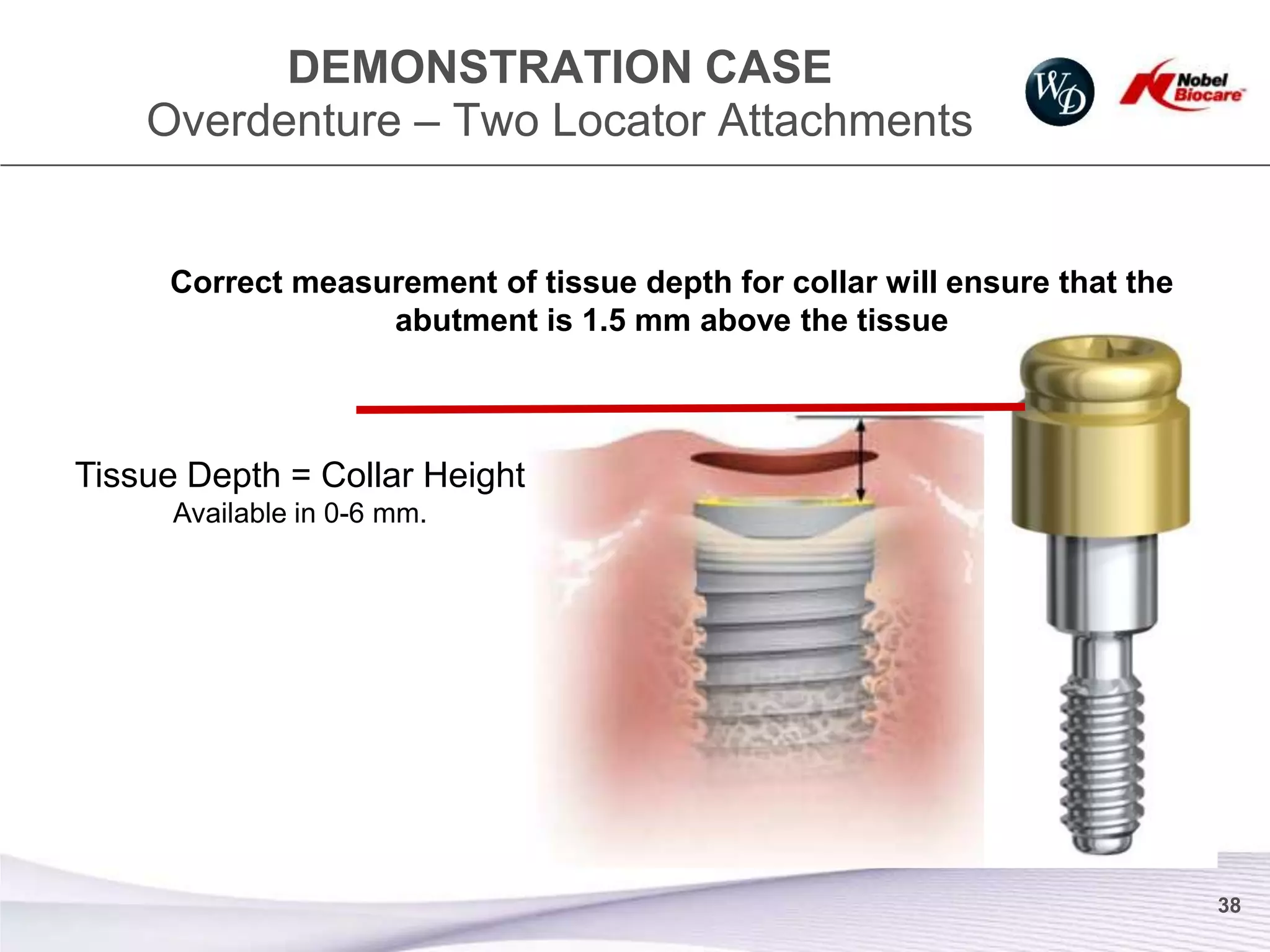 DEMONSTRATION CASE
    Overdenture – Two Locator Attachments


     Correct measurement of tissue depth for collar will ensure that the
                  abutment is 1.5 mm above the tissue



Tissue Depth = Collar Height
      Available in 0-6 mm.




                                                                           38
 