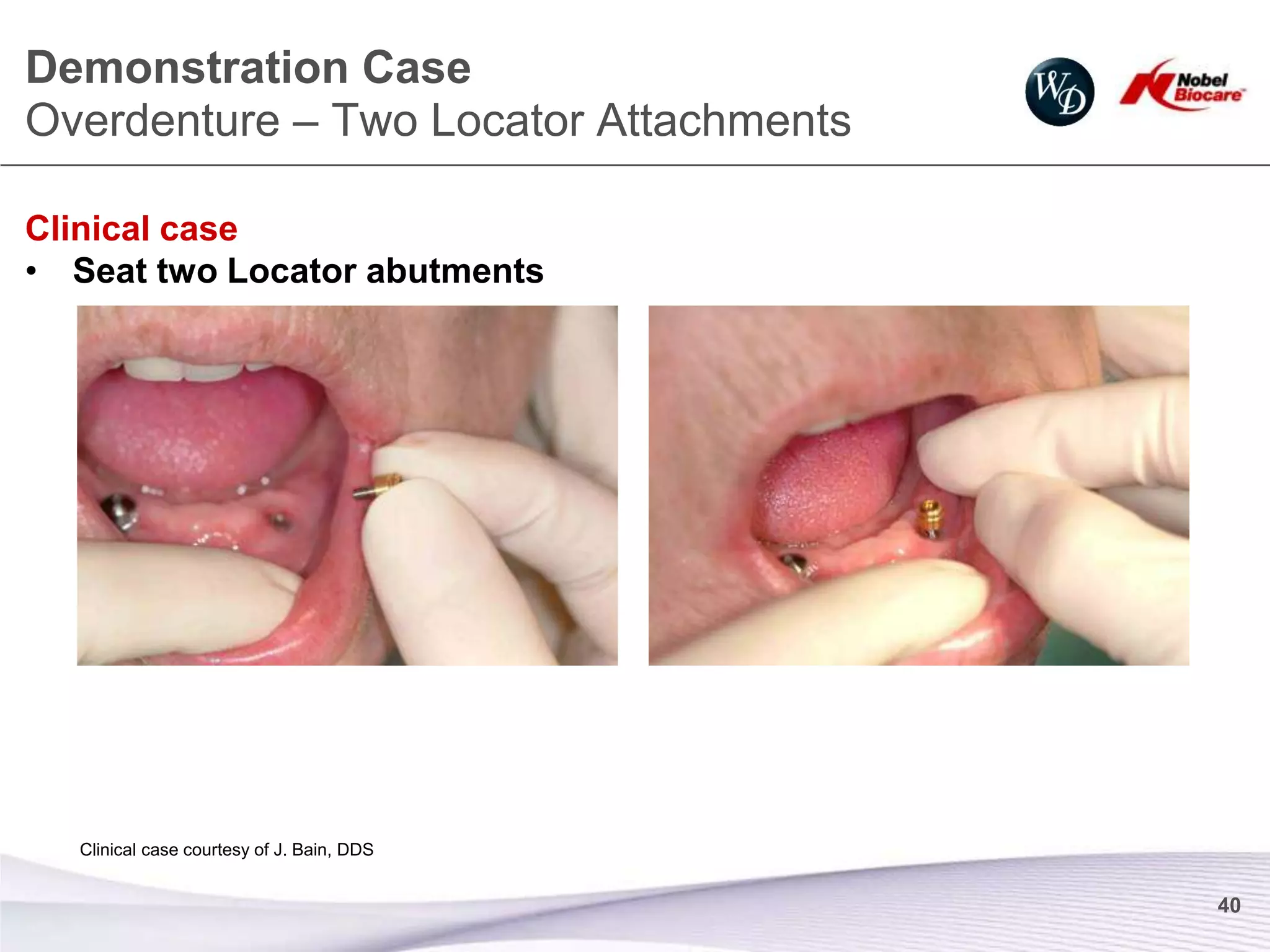 Demonstration Case
Overdenture – Two Locator Attachments

Clinical case
• Seat two Locator abutments




  Clinical case courtesy of J. Bain, DDS


                                           40
 