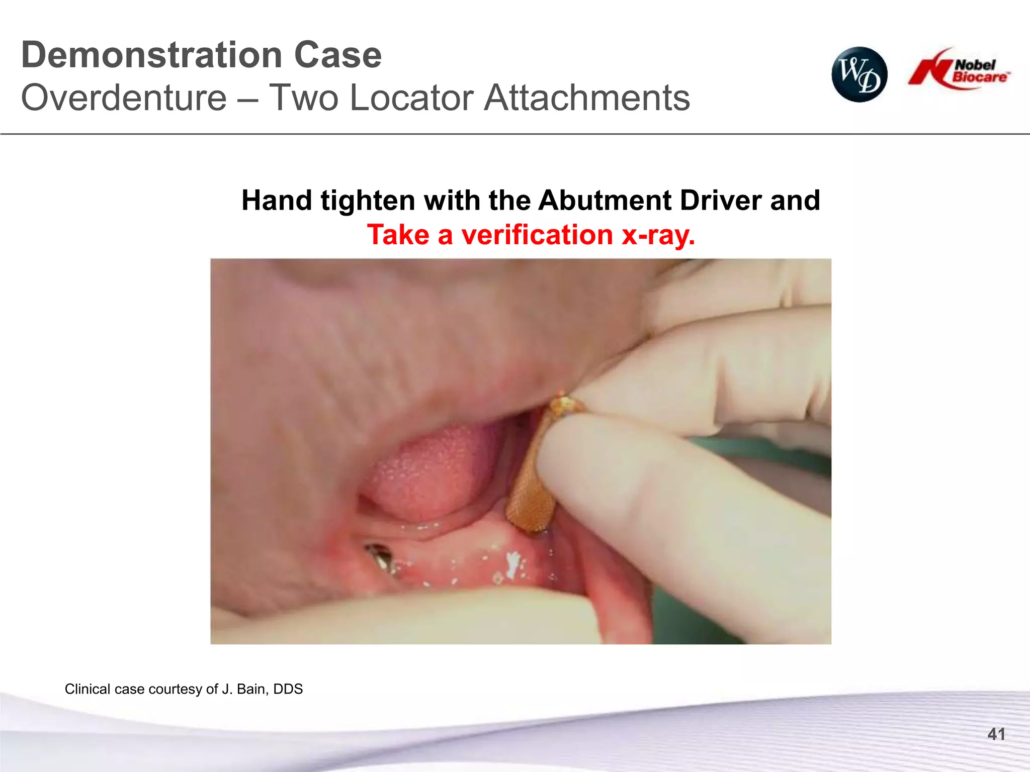 Demonstration Case
Overdenture – Two Locator Attachments

                              Hand tighten with the Abutment Driver and
                                       Take a verification x-ray.




  Clinical case courtesy of J. Bain, DDS


                                                                          41
 