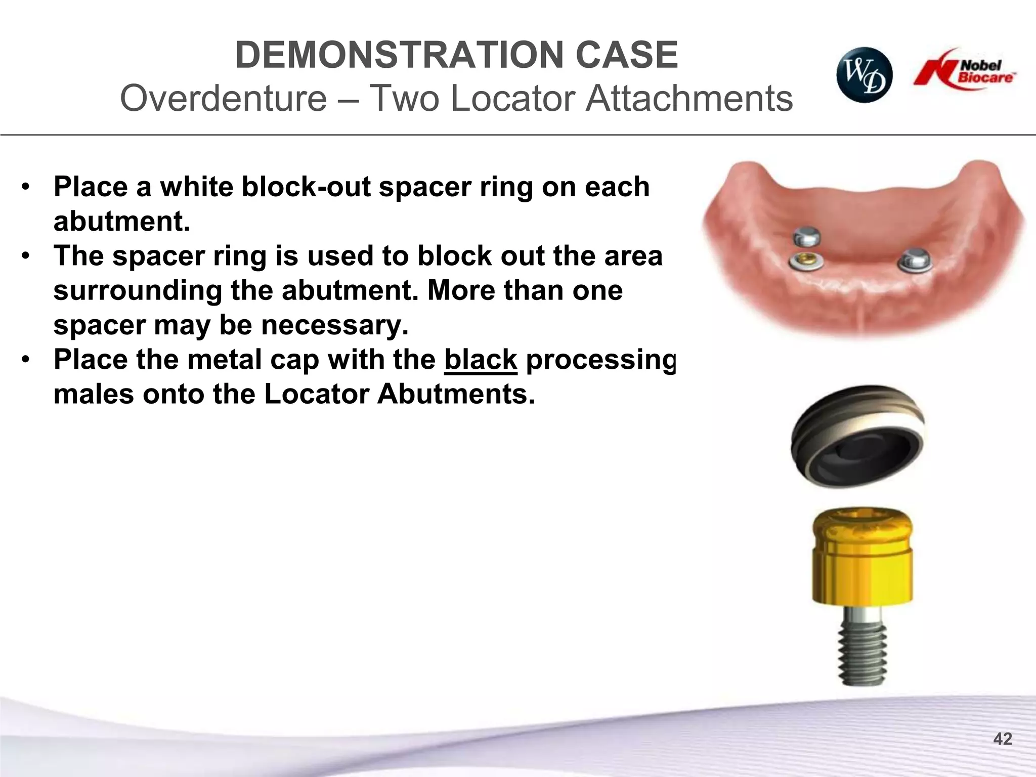DEMONSTRATION CASE
       Overdenture – Two Locator Attachments

• Place a white block-out spacer ring on each
  abutment.
• The spacer ring is used to block out the area
  surrounding the abutment. More than one
  spacer may be necessary.
• Place the metal cap with the black processing
  males onto the Locator Abutments.




                                                  42
 