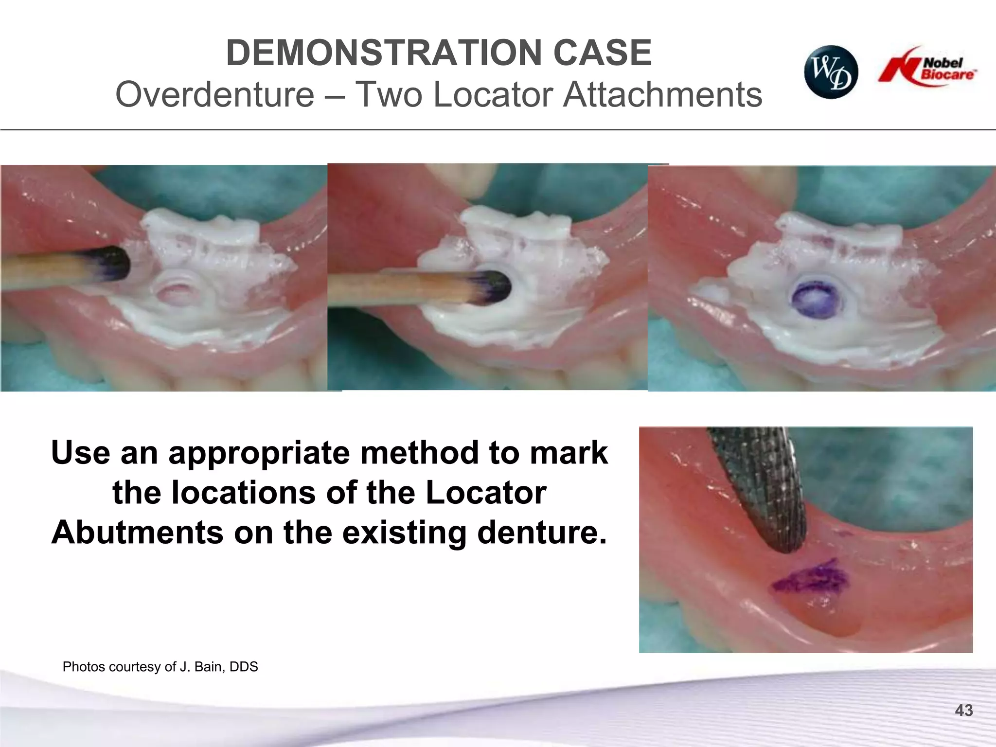 DEMONSTRATION CASE
        Overdenture – Two Locator Attachments




Use an appropriate method to mark
   the locations of the Locator
Abutments on the existing denture.


Photos courtesy of J. Bain, DDS


                                                43
 