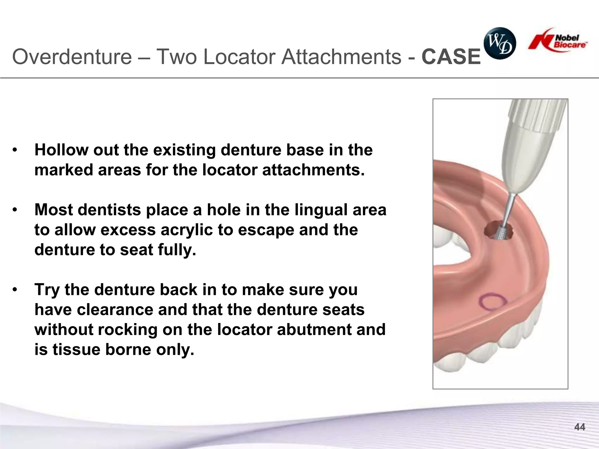 Overdenture – Two Locator Attachments - CASE



• Hollow out the existing denture base in the
  marked areas for the locator attachments.

• Most dentists place a hole in the lingual area
  to allow excess acrylic to escape and the
  denture to seat fully.

• Try the denture back in to make sure you
  have clearance and that the denture seats
  without rocking on the locator abutment and
  is tissue borne only.



                                                   44
 