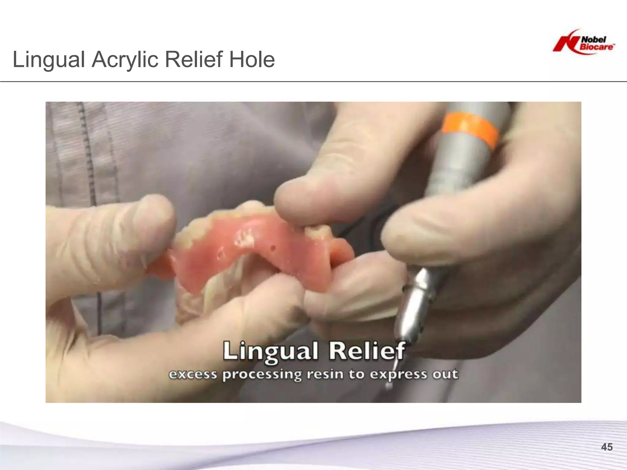 Lingual Acrylic Relief Hole




                              45
 