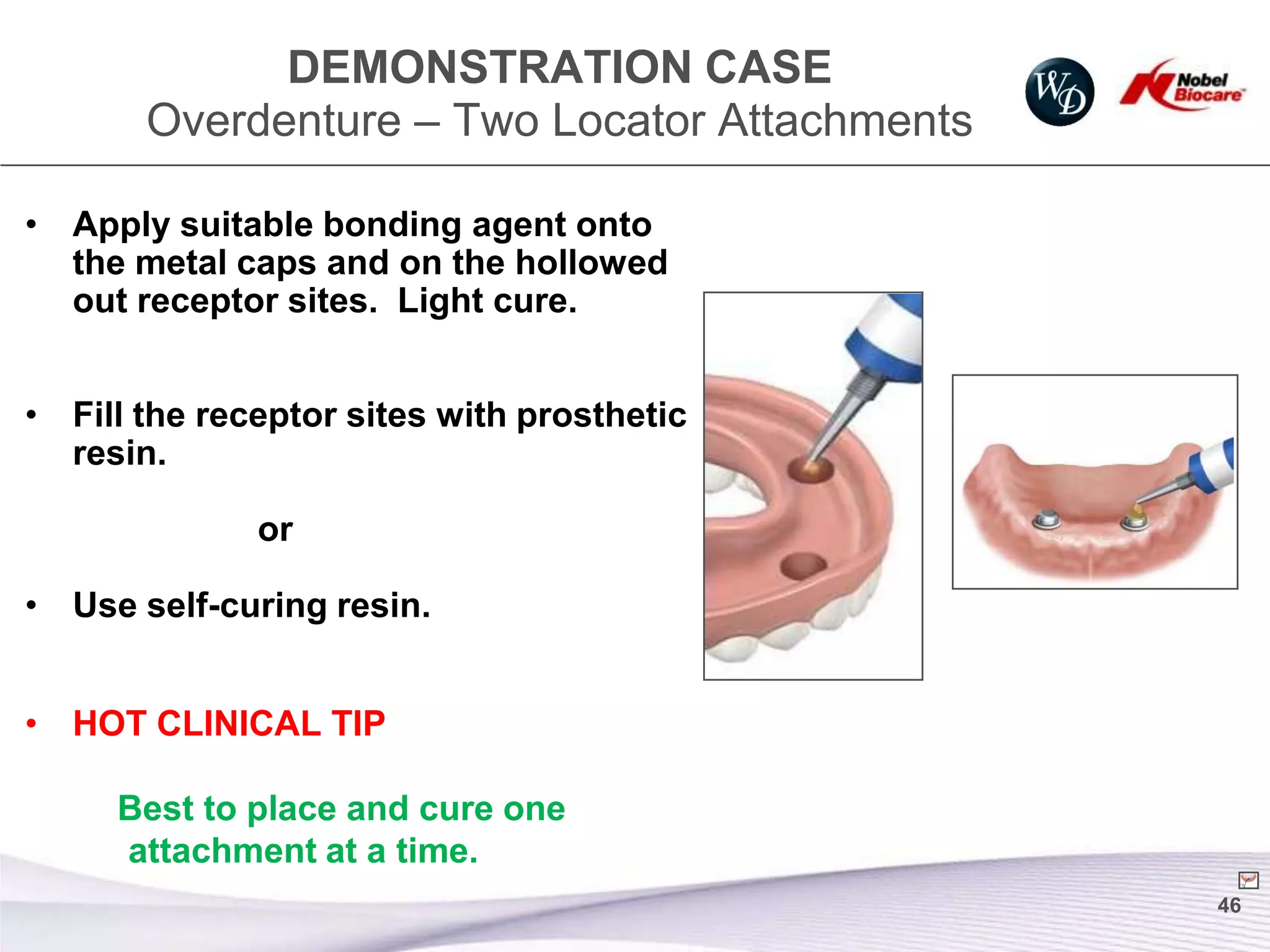 DEMONSTRATION CASE
       Overdenture – Two Locator Attachments

• Apply suitable bonding agent onto
  the metal caps and on the hollowed
  out receptor sites. Light cure.


• Fill the receptor sites with prosthetic
  resin.

              or

• Use self-curing resin.


• HOT CLINICAL TIP

     Best to place and cure one
     attachment at a time.
                                               46
 