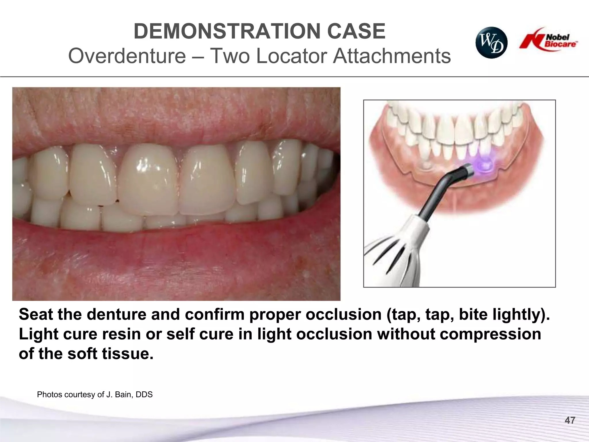 DEMONSTRATION CASE
          Overdenture – Two Locator Attachments




Seat the denture and confirm proper occlusion (tap, tap, bite lightly).
Light cure resin or self cure in light occlusion without compression
of the soft tissue.

  Photos courtesy of J. Bain, DDS


                                                                          47
 