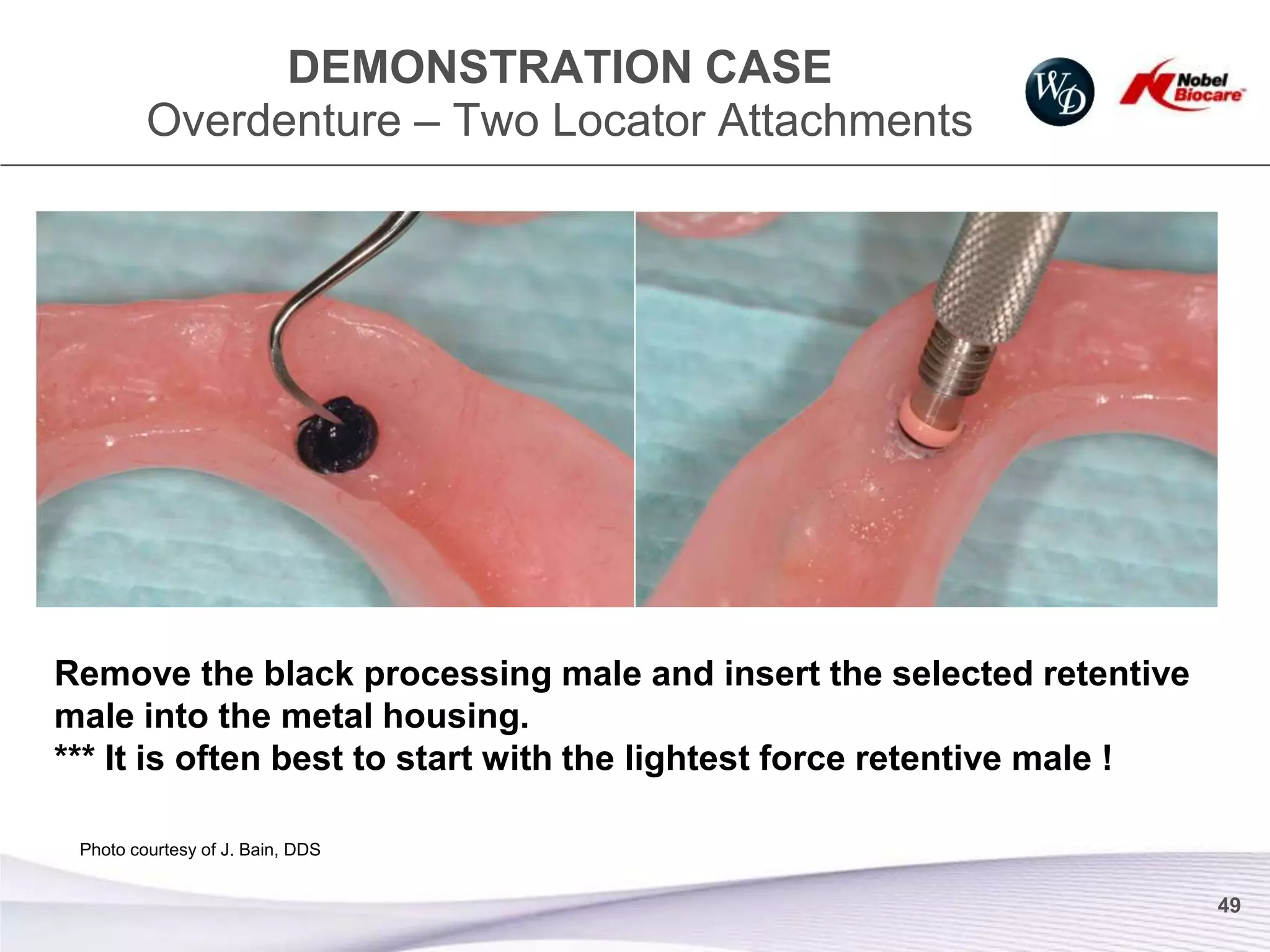 DEMONSTRATION CASE
         Overdenture – Two Locator Attachments




Remove the black processing male and insert the selected retentive
male into the metal housing.
*** It is often best to start with the lightest force retentive male !

 Photo courtesy of J. Bain, DDS


                                                                         49
 